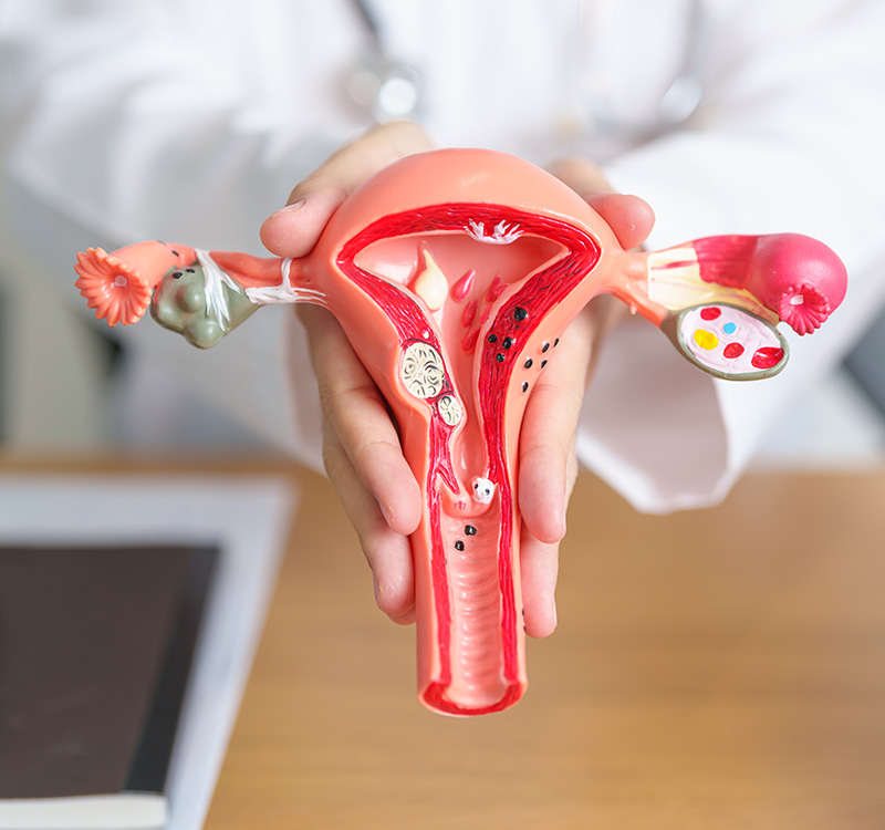 Ovarian Cysts